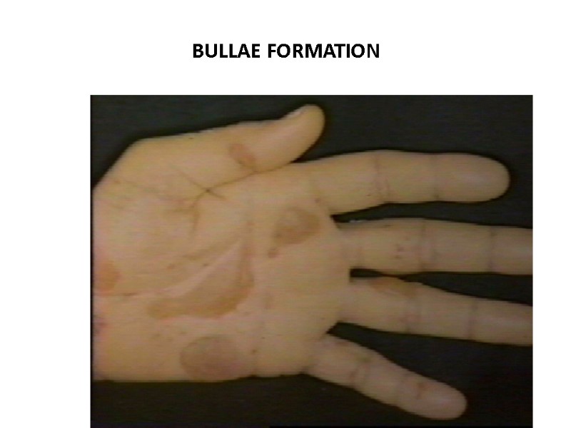 BULLAE FORMATION